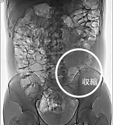 IBS2