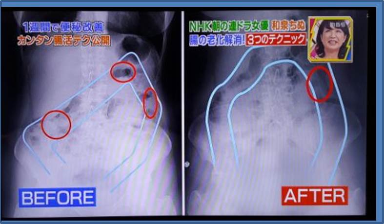 Objection 便秘 直撃 コロシアム ズバッと Tv2時間sp 宇野コラム Uno Column