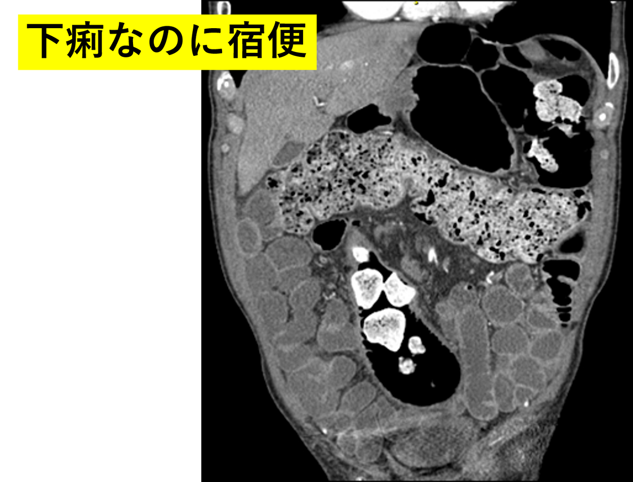 下痢なのに宿便の症例 : 宇野コラム Uno column