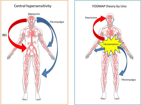 IBS Fibromyalsia