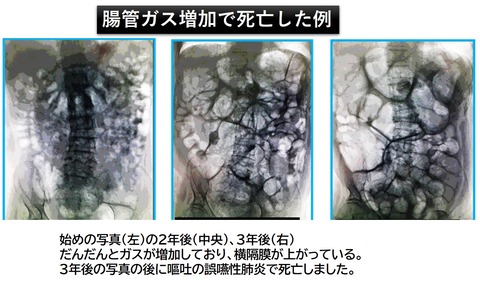 ガス脂肪