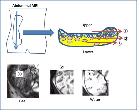 MRI