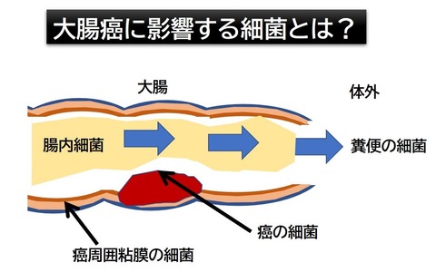 大腸癌