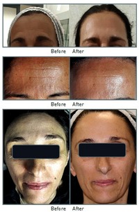 md-peeling-2