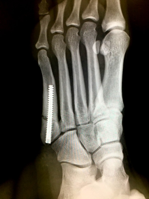 左第5中足骨 疲労骨折 馬のしっぽ 左第5中足骨 疲労骨折 馬のしっぽ