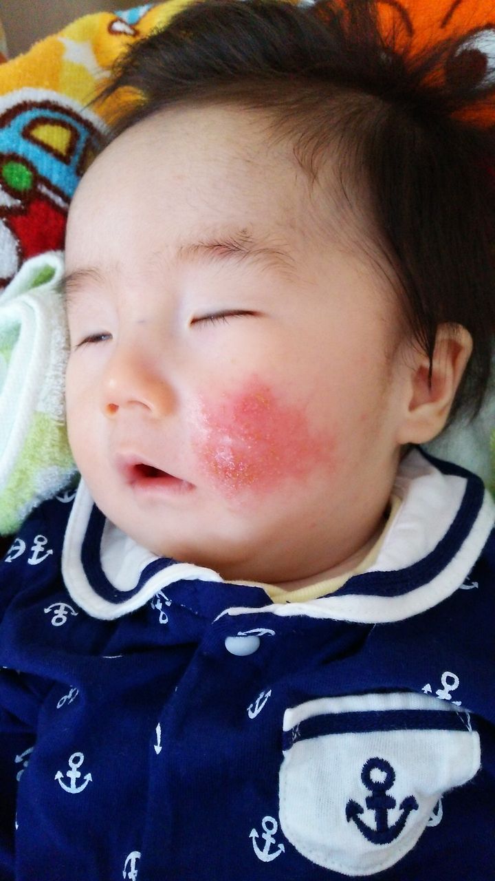 ほっぺた事情 きらきらひかる ほっぺた事情 きらきらひかる
