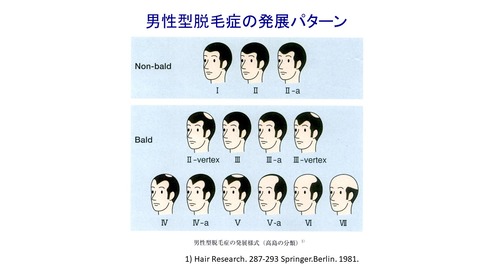 男性型脱毛症