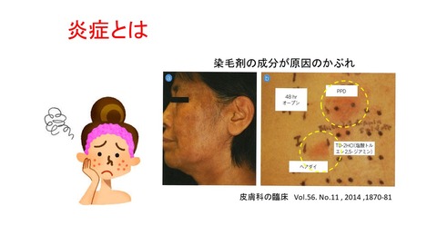 炎症とは