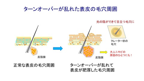 ターンオーバーと毛穴の関係