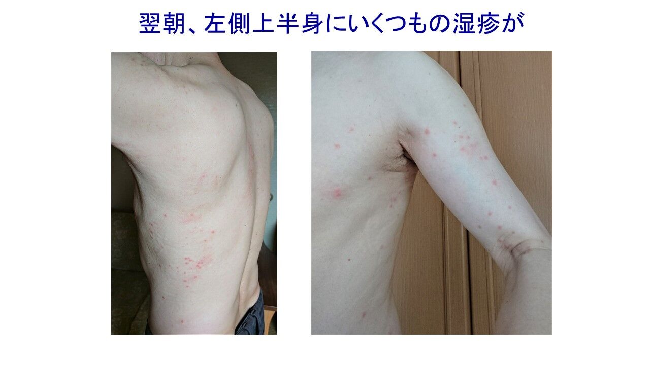 チャドクガに注意 アナトミー村本の若肌研究所 Wakahada Research チャドクガに注意 アナトミー村本の若肌研究所 Wakahada Research