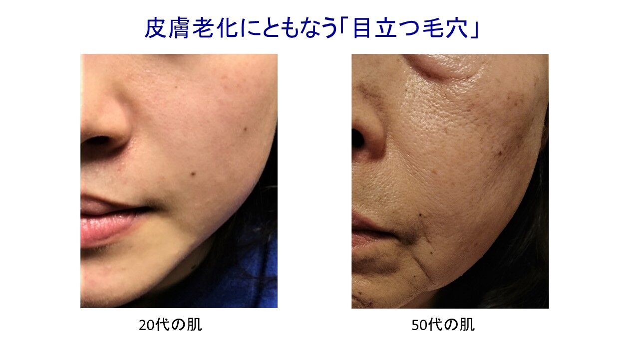 君子毛穴に近寄らず アナトミー村本の若肌研究所 Wakahada Research