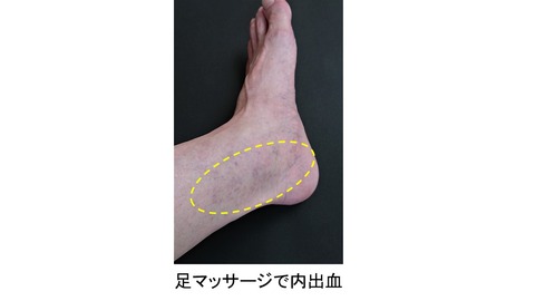 足の内出血