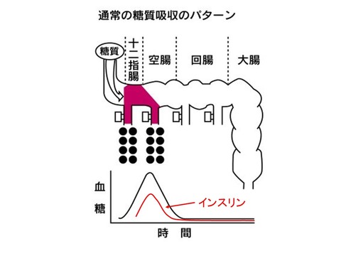 インスリン急上昇
