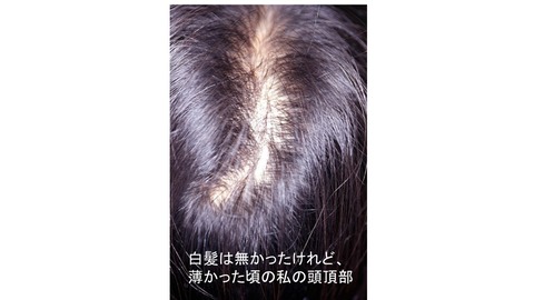 頭頂部