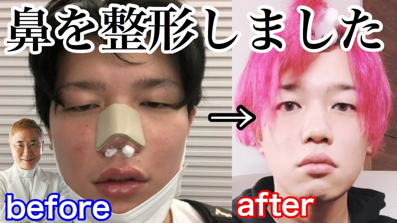 よりひと ガチで鼻整形したらダウンタイムがヤバすぎた デメリット Youtuberコメ速報 よりひと ガチで鼻整形したらダウンタイムがヤバすぎた デメリット Youtuberコメ速報