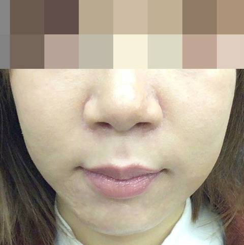 術後の顔の変化 術後1 3カ月 最短で顎変形症を治すブログ