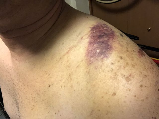 50代男性鎖骨骨折の記録 Jn1sut Blog 50代男性鎖骨骨折の記録 Jn1sut Blog