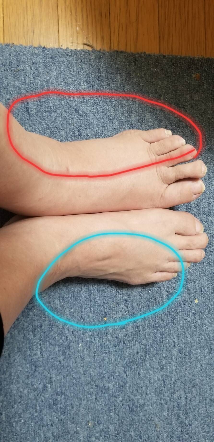 痺れに注意 よしりんの つれづれなるままに 痺れに注意 よしりんの つれづれなるままに