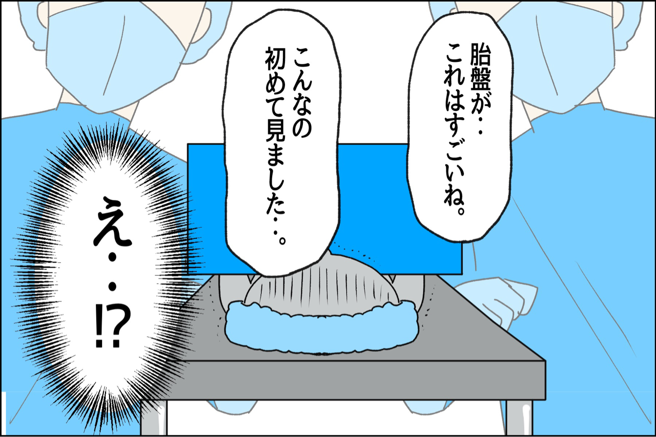 ゼクシイ】緊急帝王切開と癒着胎盤を経験して思ったことはu2025 : 笑う母に 