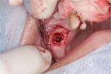 cavitation