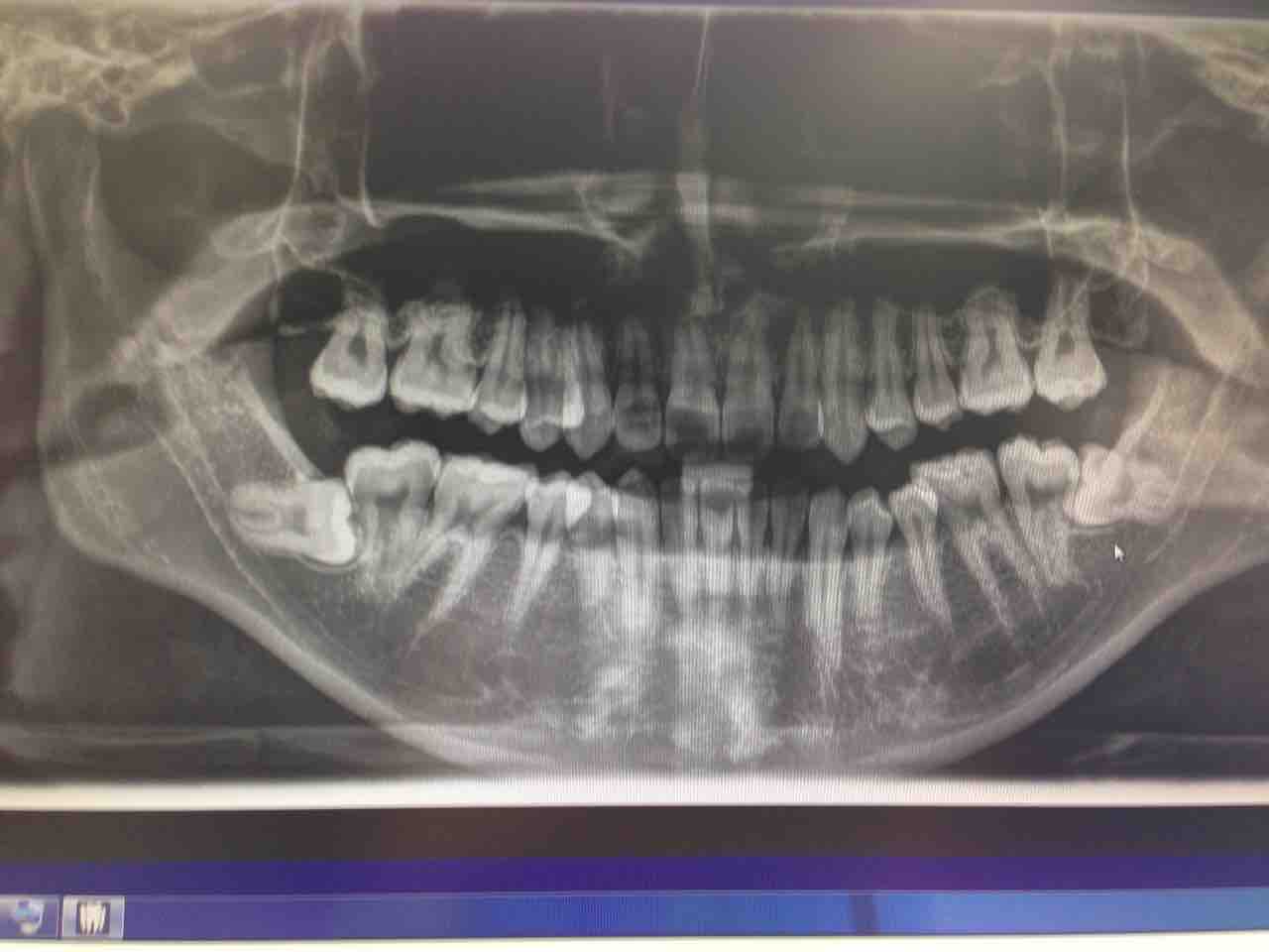 親知らず２本抜歯 入院が決定しました ユキ旦那 サラリーマンyoutuberのブログ