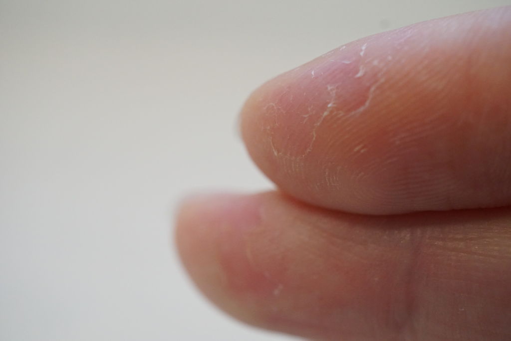 止められないクセ 指の皮を噛んで食べてしまう ゆきだるま日記