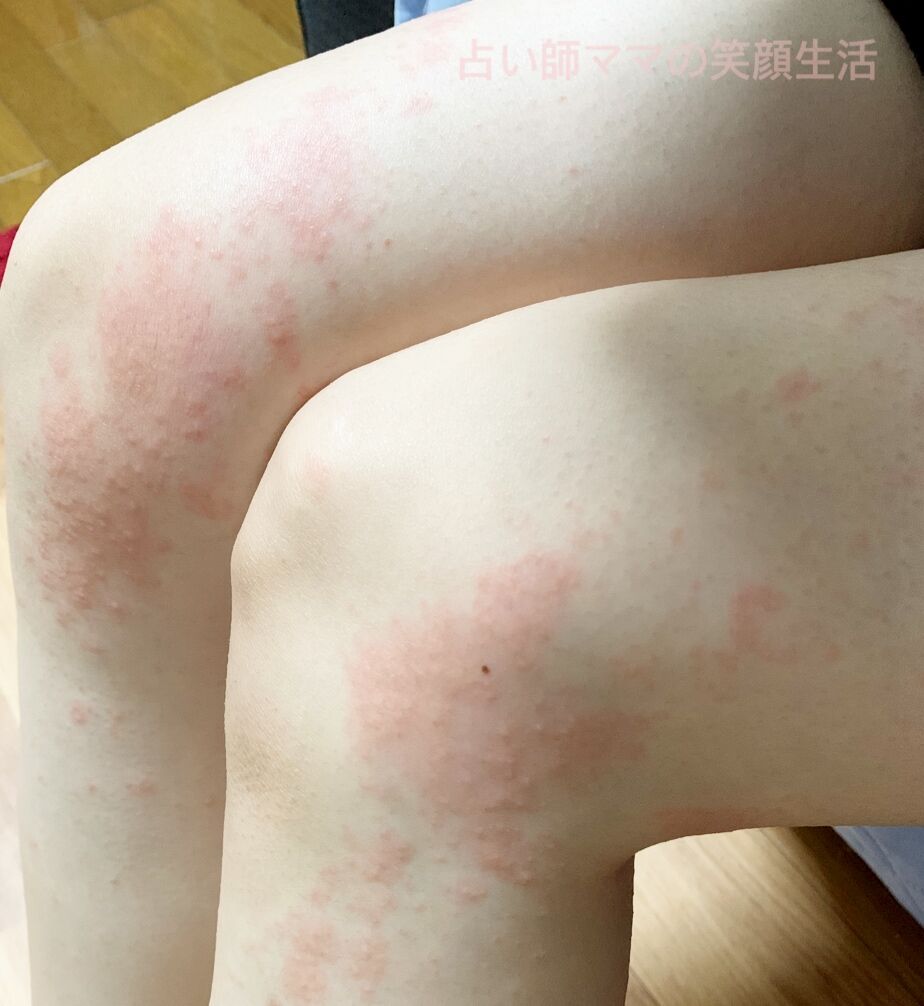 妊娠性痒疹の経過1 占い師ママの笑顔生活