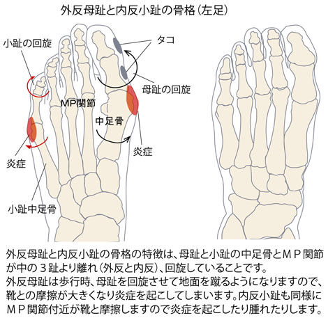 外反母趾と内反小趾の骨格