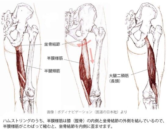 半腱様筋・半膜様筋の変調と坐骨結節の歪み