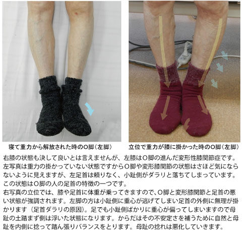O脚の人の足首と足