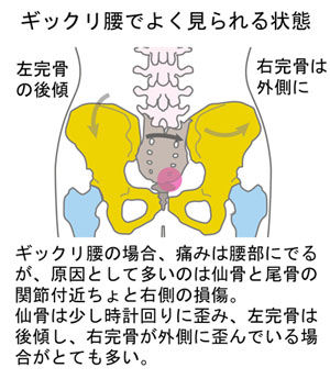 ギックリ腰でよく見られる状態