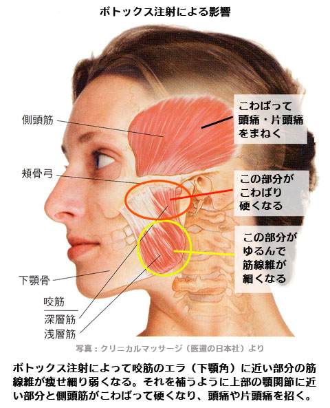ボトックス注射による影響
