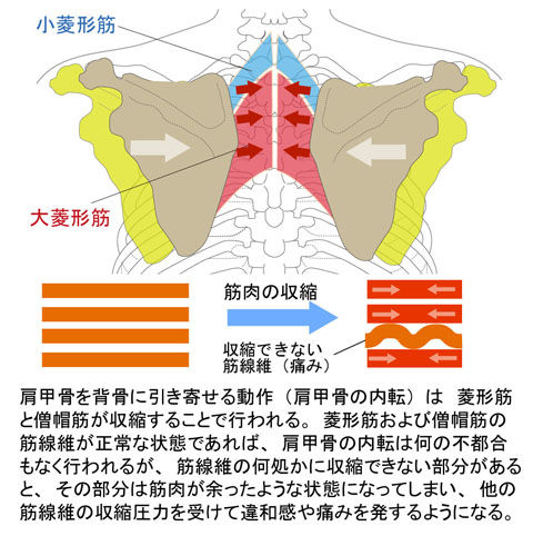 菱形筋と僧帽筋の「ゆ」による背中の痛み