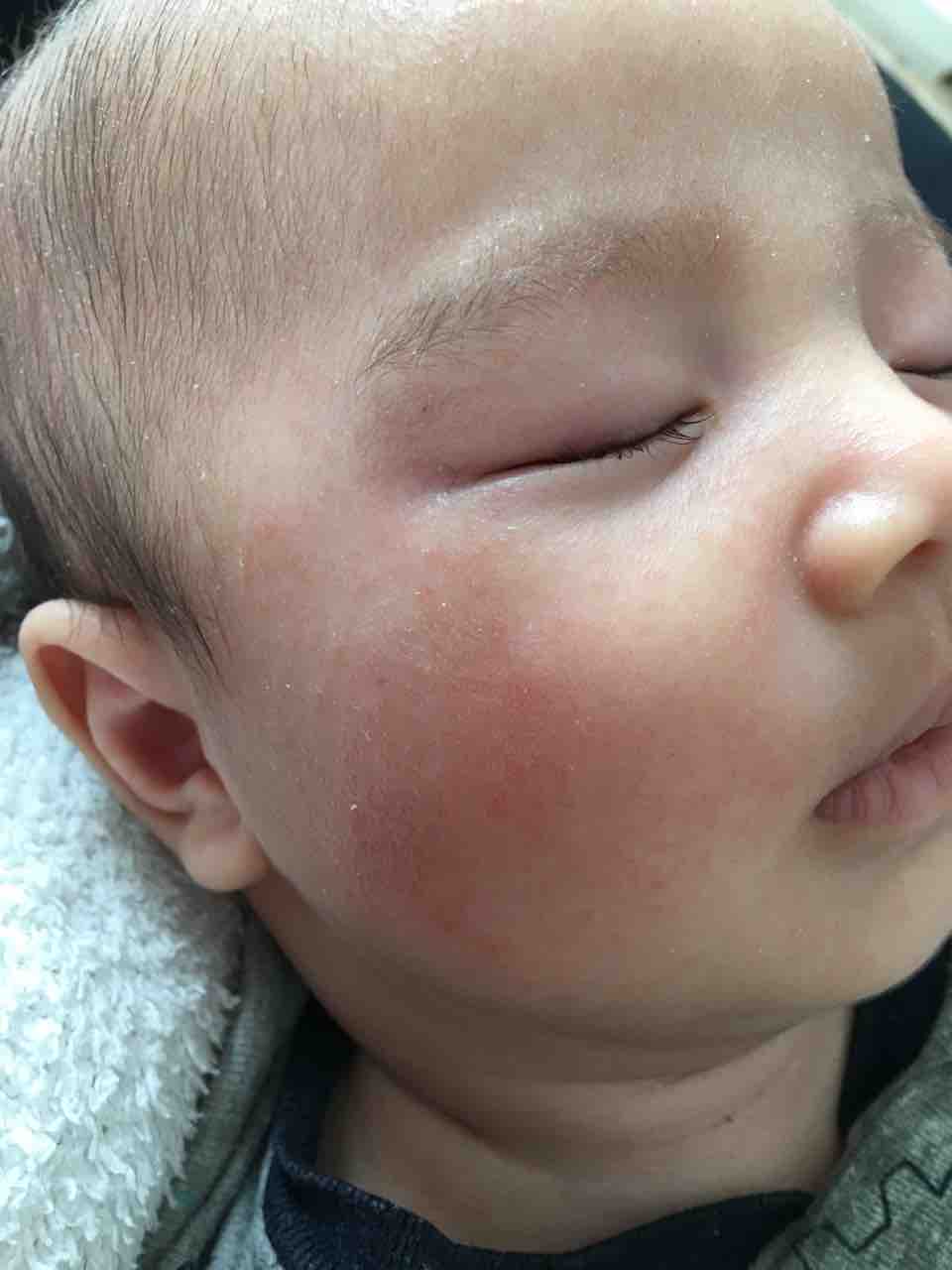 アトピーな息子 ネガティブママのアレルギーっ子 子育て