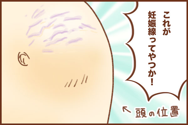 妊娠線 ゆむい