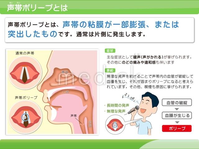 声帯の腫れ 治し方 – 声が出ない 声帯 – CEQP