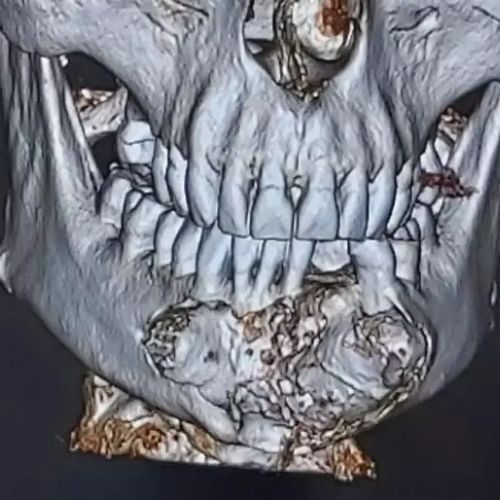 歯医者　腫瘍　手術に関連した画像-04