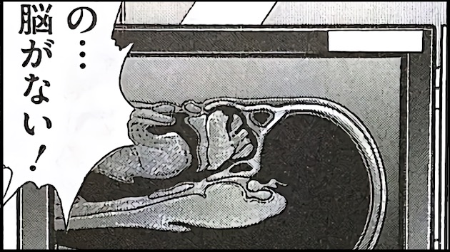 脳が半分なかったに関連した画像-01