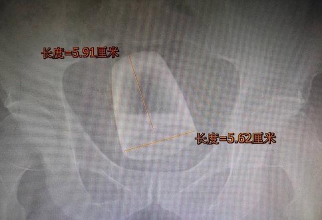 肛門 ビールグラス 手術 中国
