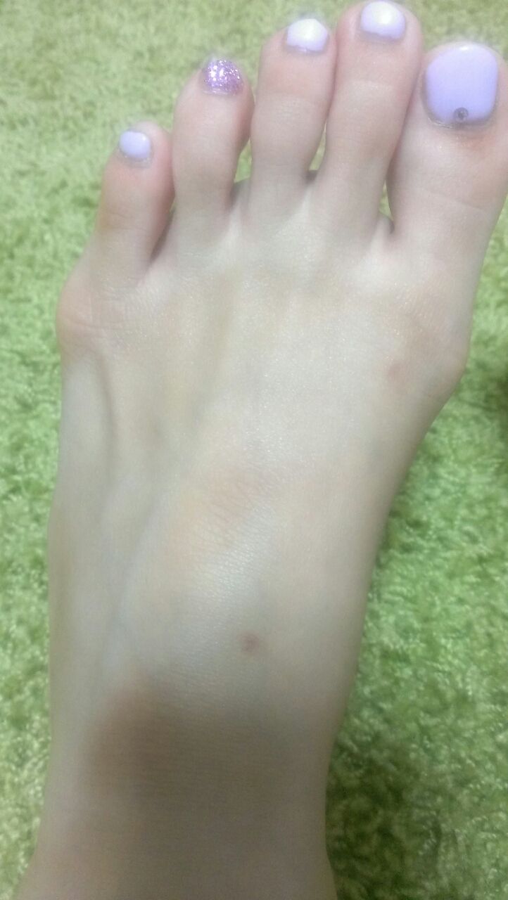 日焼けの代償 あたしのノート