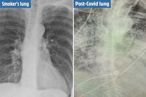 コロナ感染者の肺のレントゲン画像 喫煙者よりもヤバイと話題に