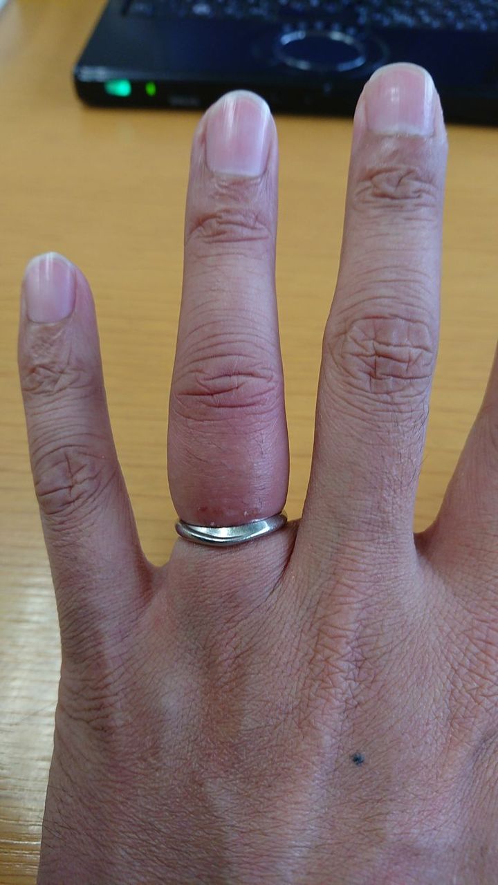 指輪うっ血騒動を 一筆書きで 垣田裕介の研究室 別館 余暇のブログ