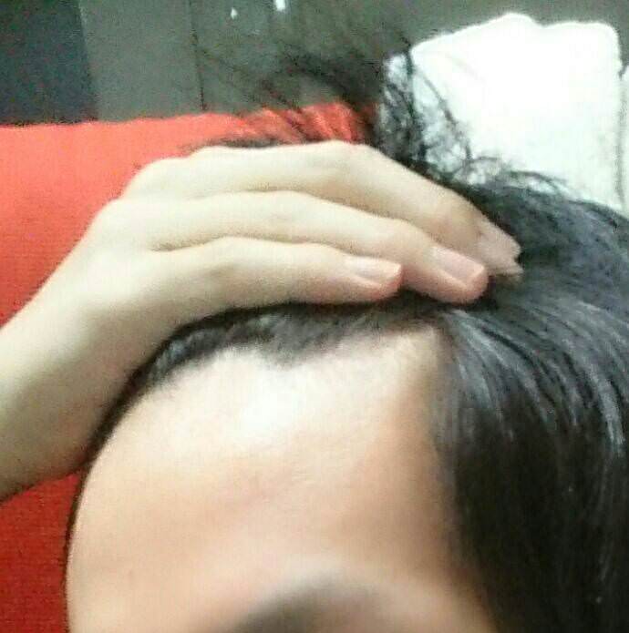 悲報 ワイ19歳 前髪のハゲが止まらない 薄毛速報 悲報 ワイ19歳 前髪のハゲが止まらない 薄毛速報