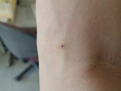 刺された