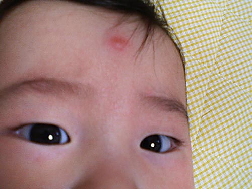 男の勲章 Byパパ ゆうやとはるかのすくすく日記 男の勲章 Byパパ ゆうやとはるかのすくすく日記