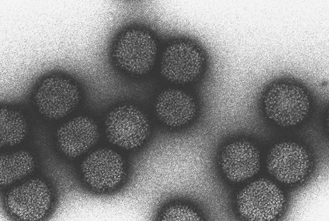 アルツハイマー発症率31倍、インフルエンザの脳炎、肺炎など