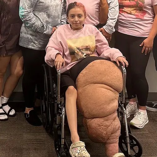 【衝撃】14歳のアメリカ人少女さん、手術で約80kgの「減量」に成功・・・・・・・・・