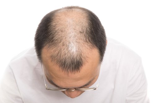 【爆笑】歌詞の「君」を「髪」に変えるとガチでハゲへの応援歌になるｗｗｗｗｗｗｗｗｗｗ