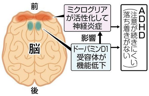 【悲報】「ASD」「ADHD」「不安障害」「双極性障害」←この中に1つだけガチで救いがない障害が混じってるｗｗｗｗｗｗｗｗｗｗ