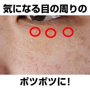 目の周りにある 稗粒腫 白いブツブツ ライフハック2chメモ 目の周りにある 稗粒腫 白いブツブツ ライフハック2chメモ